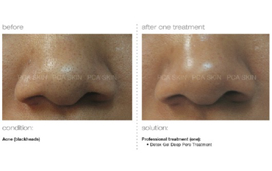 detox_deep_pore_treatment