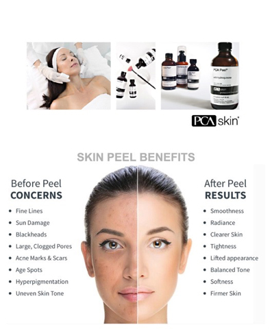 pca_skin_peels